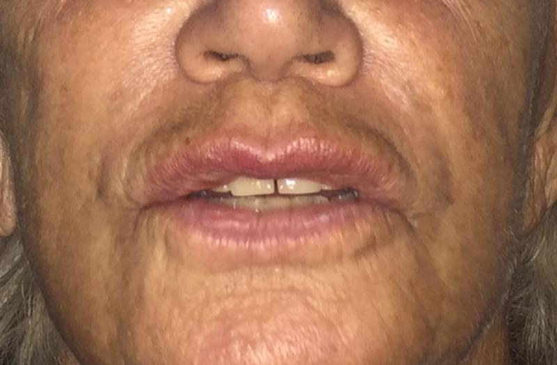 Lip augmentation, Lip enlargement, Lip enhancement, Fat Injection, Fat grafting