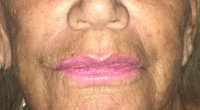 Lip augmentation, Lip enlargement, Midface Lift, Fat Injection, Fat grafting
