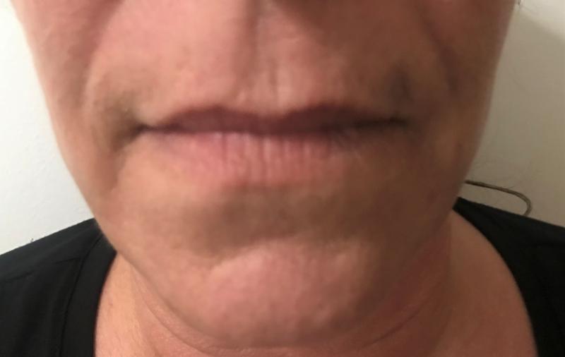 Lip Fillers, Lip augmentation, Lip Wrinkles, Juvederm, Best Cosmetic Surgery 