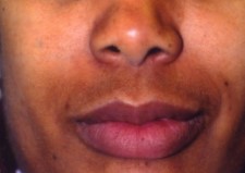 Lip surgery, Lip reduction Surgery, Best Plastic Surgery, Lip Restylane Cosmetic