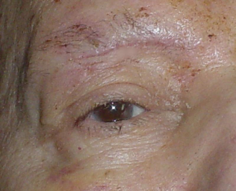 Plastic Surgery Egypt face lift Wounds scar deformity juvederm botox Wilson nose