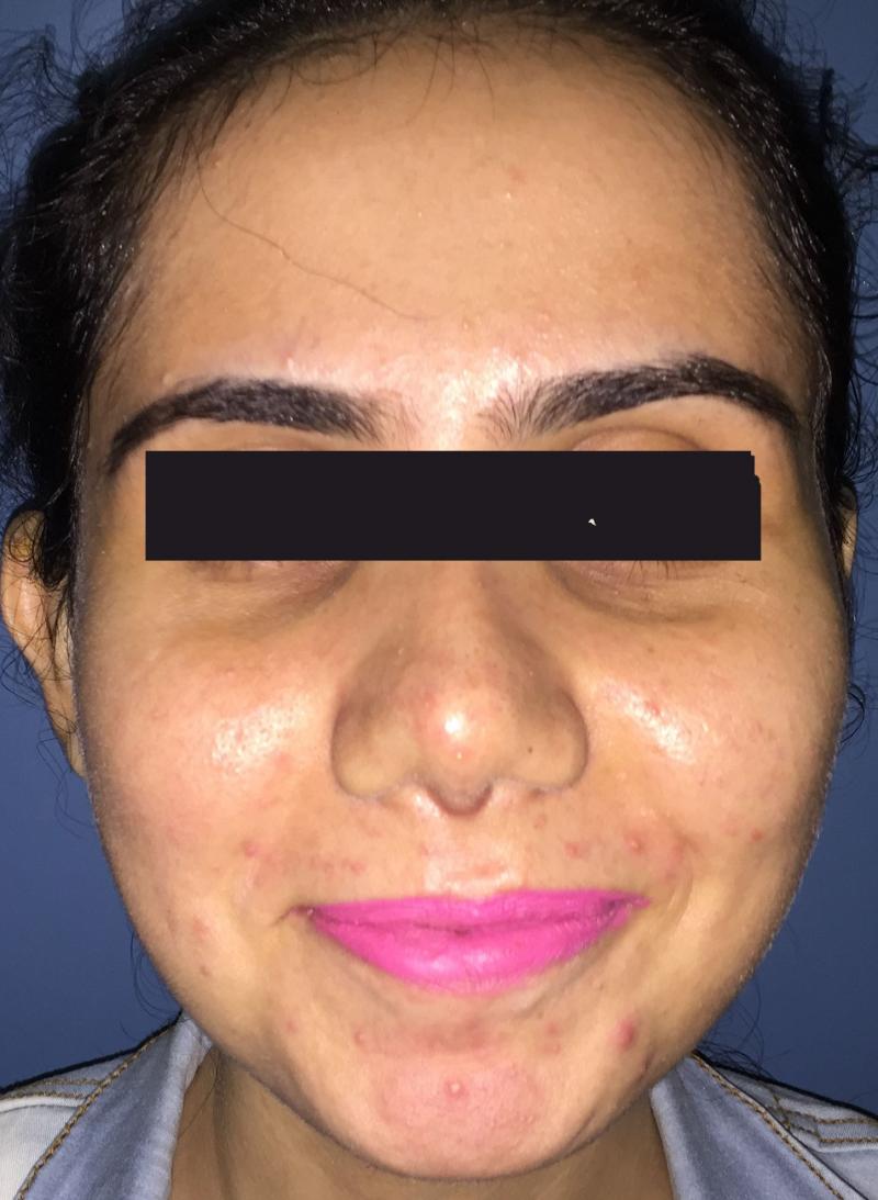 Rhinoplasty Egypt, Nose Job, Nose Tip, Boxy tip, Best Plastic Surgery, Nose open