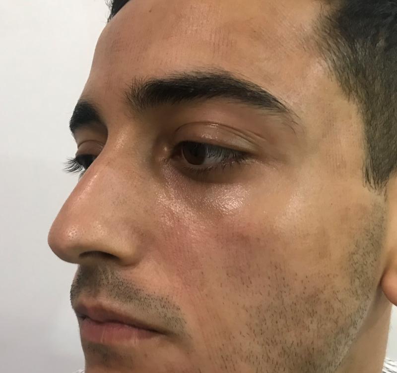 Drooping tip and crooked nose for rhinoplasty at Best Plastic Surgery in Egypt