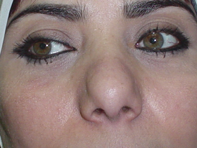 Plastic Surgery in Egypt, Secondary Nose surgery, Secondary tip Rhinoplasty, 