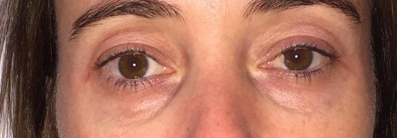 Tear trough Eyelid, Eyelid wrinkles, Eyelid surgery, Blepharoplasty, Restylane