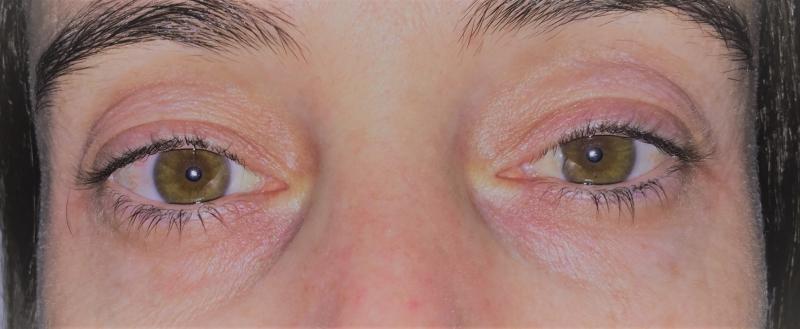 Tear trough Eyelid, Eyelid wrinkles, Eyelid durgery, Blepharoplasty, Juvederm