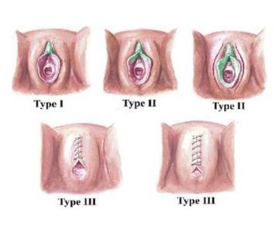 FGM grades, Clitoris, Clitoris reconstruction, labia minora, Labiaplasty, Sexua