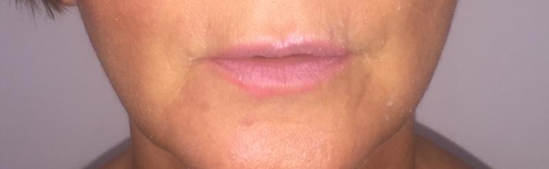 Lip Fillers, Juvederm Filler, Upper Lip Filler, Cosmetic Surgery Egypt Best
