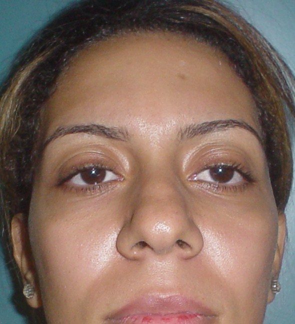 Sunken Cheeks, Fillers, Restylane, Nasolabial Wrinkles, Best Esthetic Surgery