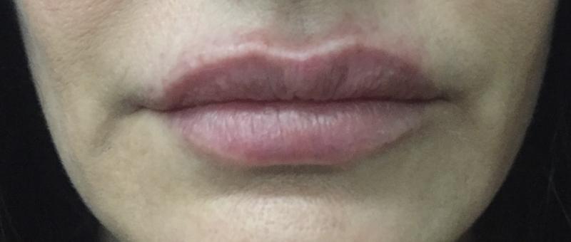 Lip Filler, Lip Enhancement, Dimple Creation, juvederm, Best Plastic Surgery
