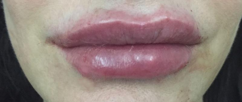 Lip Filler, Lip Enhancement, Dimple Creation, Restylane, Best Plastic Surgery
