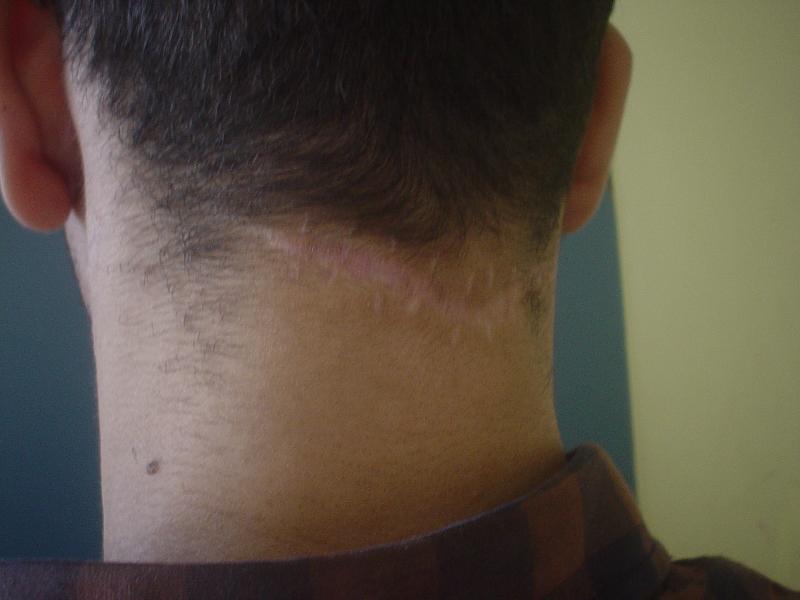 Scars in Egypt, Botox in Egypt, Cosmetic Surgery in Egypt, Best Plastic Surgeon