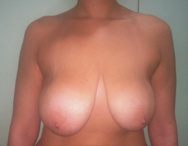 Breast Reduction, Breast Lift, Breast Enlargement, Breast mastopexy,Best Plastic