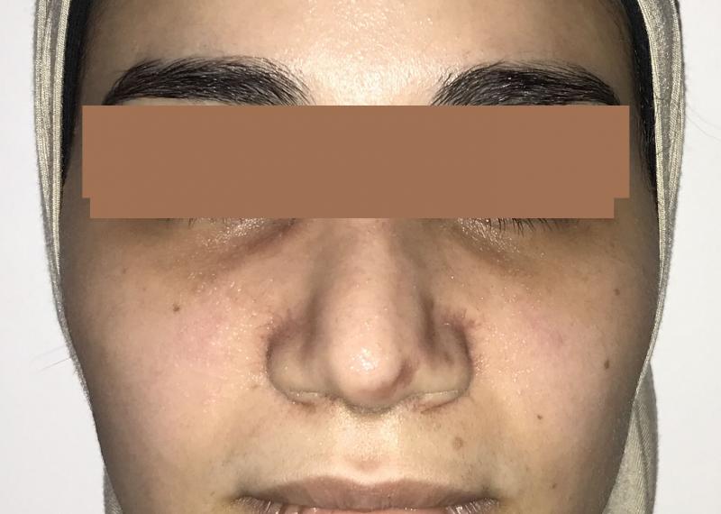 Deviated nose, hump corrected by Nose Job Rhinoplasty at Best Cosmetic Surgery 