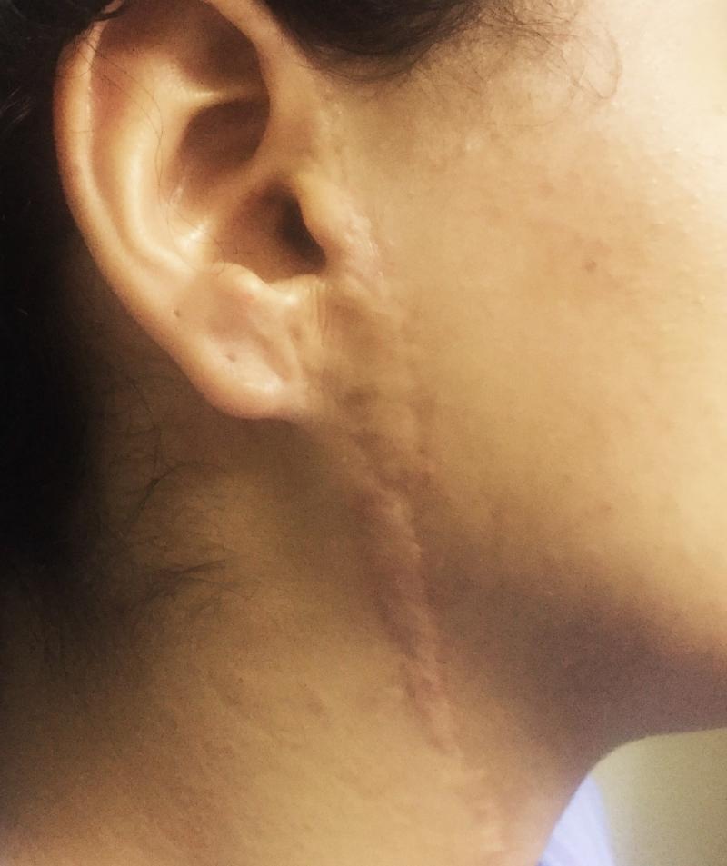 Botulinum Toxin, Cosmetic Surgery Egypt, Face Scar, Wide Scar, Laser Vaser Lipo