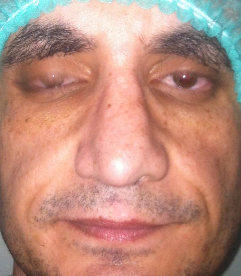 Nose Job Egypt, Rhinoplasty Egypt, Irregular Dorsum, Best Cosmetic Surgeon Egypt